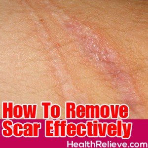 How To Remove Scar | HealthRelieve.com