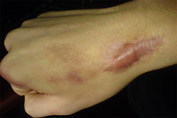 7 Amazing Home Remedies for Keloids 7 Amazing Home Remedies for Keloids