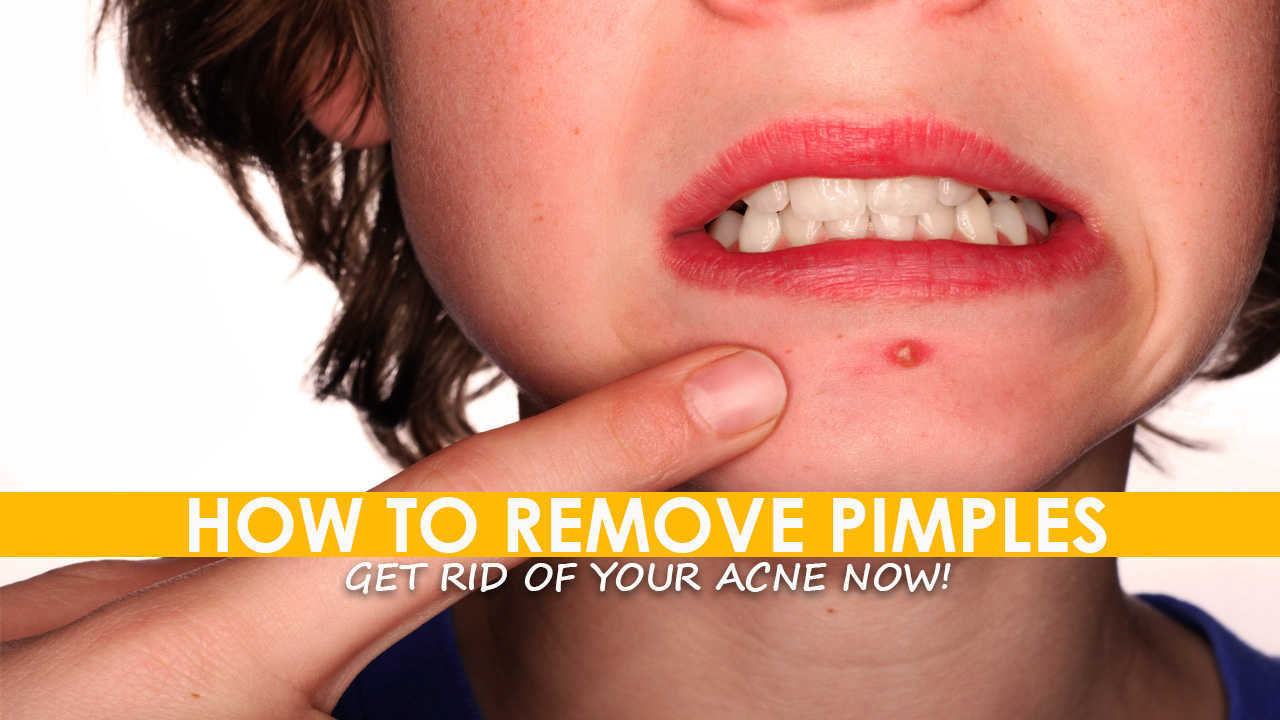 how to remove pimples