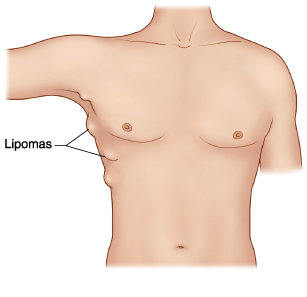 how to cure lipoma